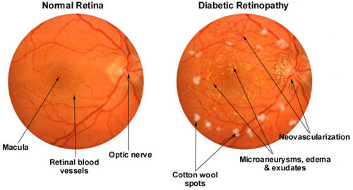 diabetic-retinopathy-large[1]